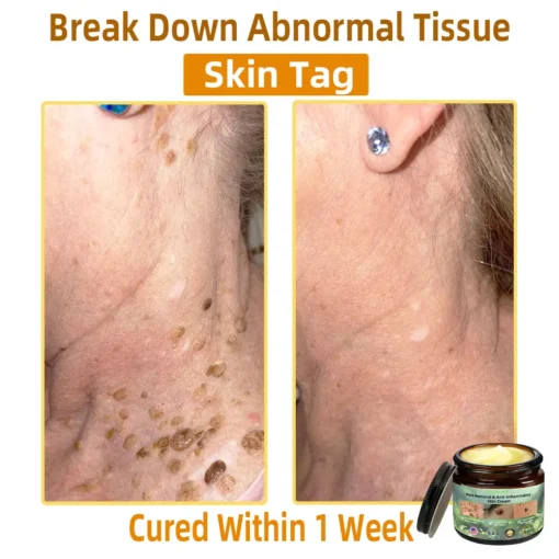 Bostore™ Mole Removal & Anti-Inflammatory Skin Cream