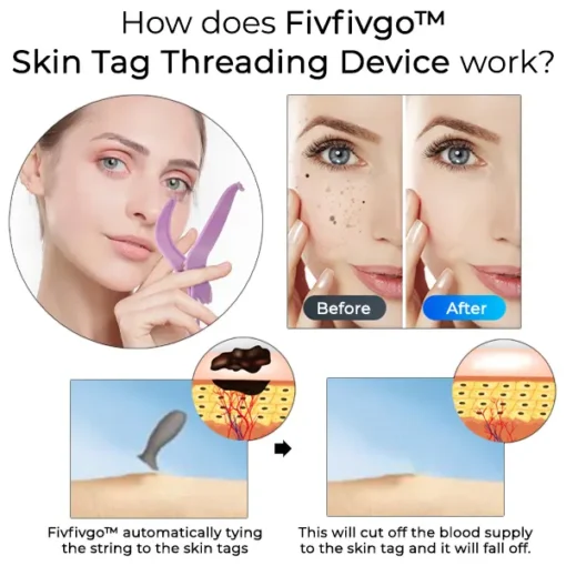 Fivfivgo™ Skin Tag Threading Device